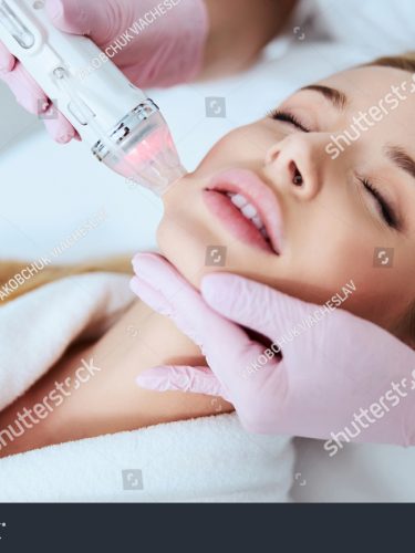 Microneedling